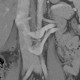 Retroaortic renal vein, duplication of renal vein: CT - Computed tomography